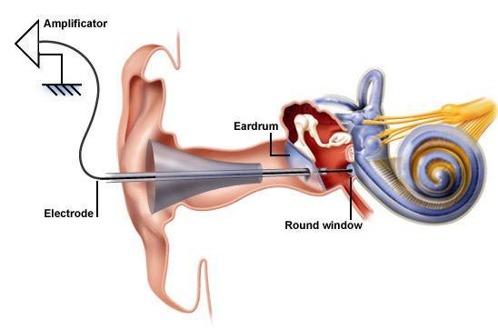 Hearing Aid Centre Chennai Electrococheleography(ECOG or ECochG)  