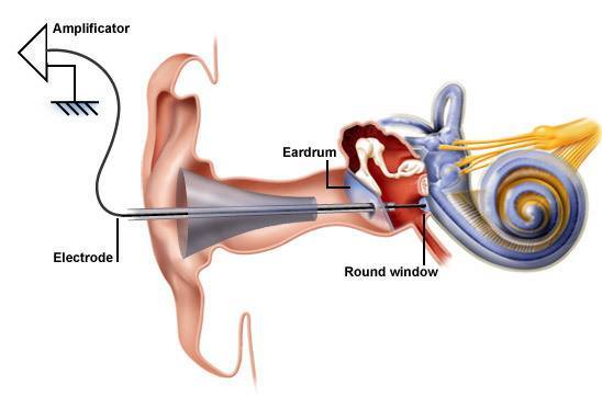 Hearing Aid Centre Chennai Electrococheleography(ECOG or ECochG) 