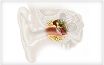 Hearing Aid Centre Chennai What is Hearing Loss  