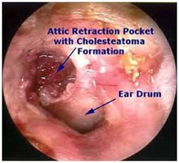 Hearing Aid Centre Chennai Middle Ear & Diseases Related To It 