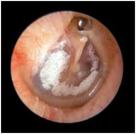 Hearing Aid Centre Chennai Middle Ear & Diseases Related To It 