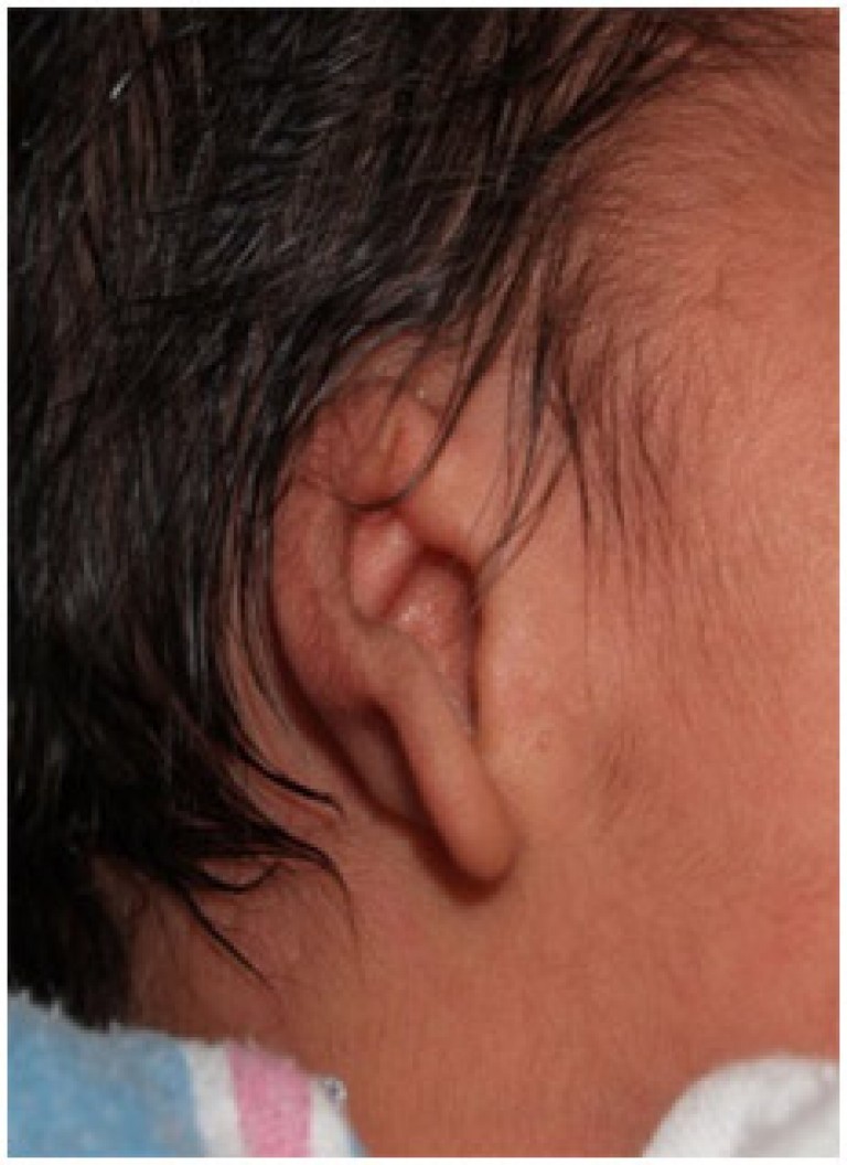 Hearing Aid Centre ChennaiOuter Ear & Diseases Related To It