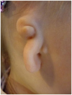 Hearing Aid Centre Chennai Outer Ear & Diseases Related To It 