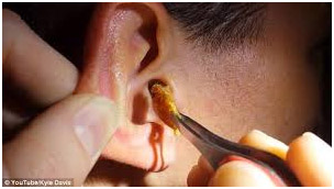 Hearing Aid Centre Chennai Outer Ear & Diseases Related To It 