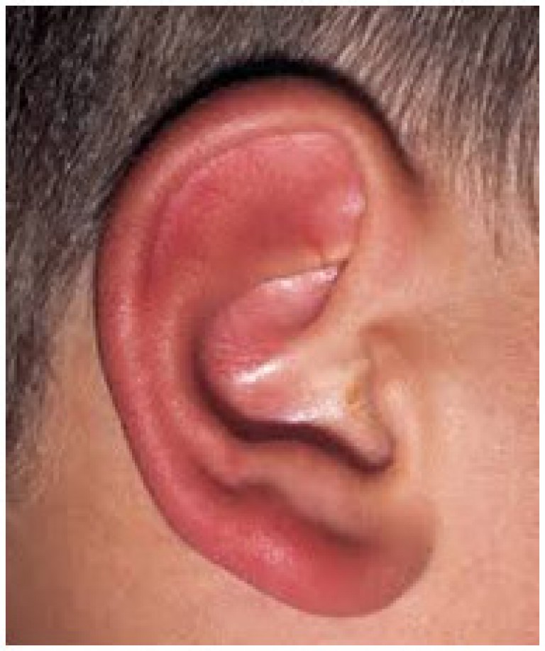 Hearing Aid Centre ChennaiOuter Ear & Diseases Related To It