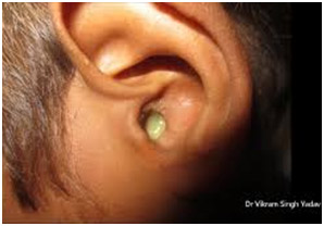 Hearing Aid Centre Chennai Outer Ear & Diseases Related To It 