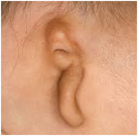 Hearing Aid Centre Chennai Outer Ear & Diseases Related To It 