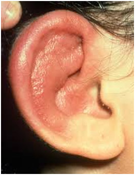 perichondritis outer eardrum rupture