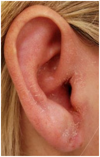 Hearing Aid Centre Chennai Outer Ear & Diseases Related To It 