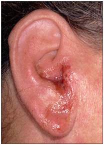 Hearing Aid Centre Chennai Outer Ear & Diseases Related To It 