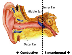Hearing Aid Centre Chennai What is Hearing Loss  
